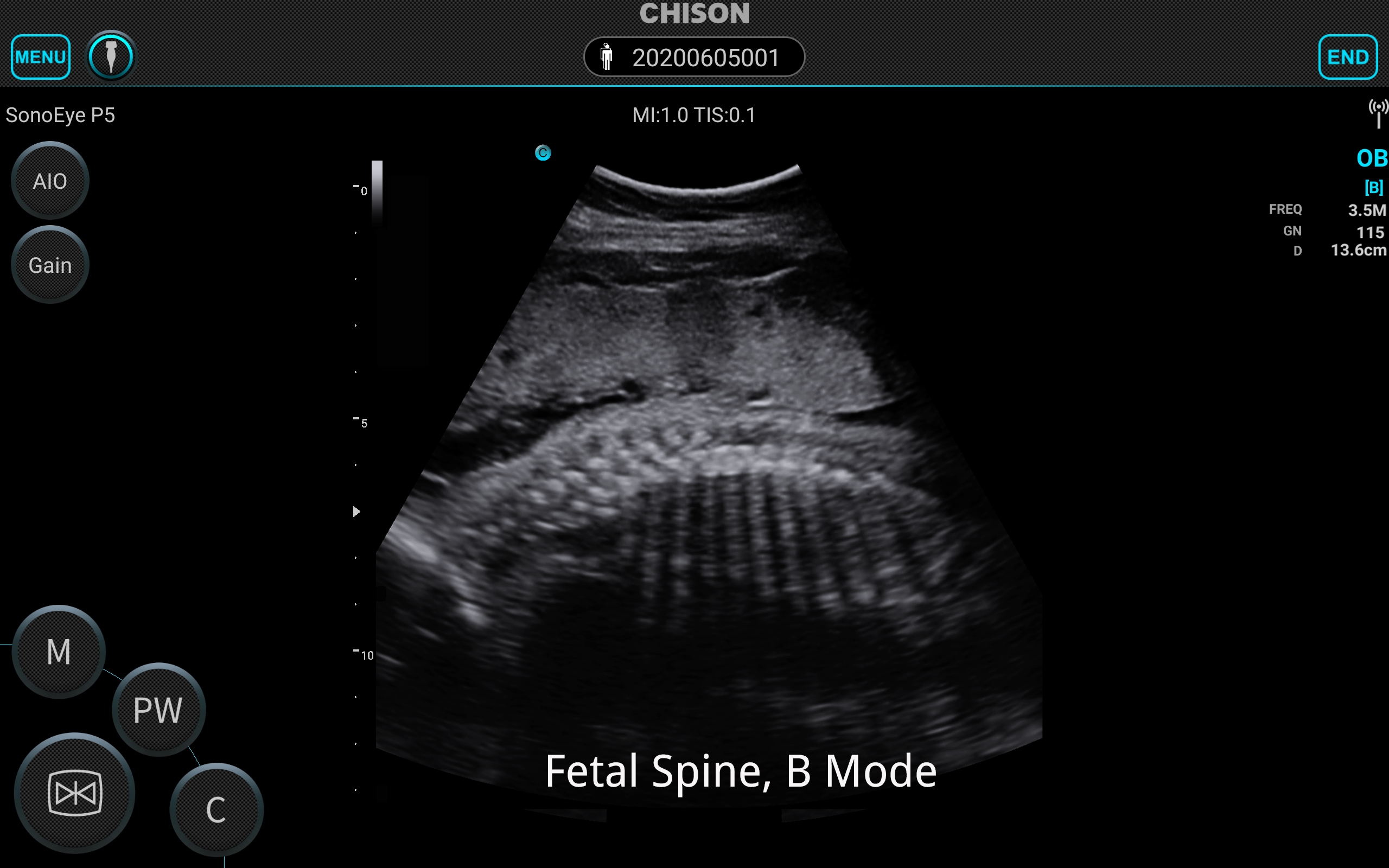 SonoEye Fetal Spine B Mode